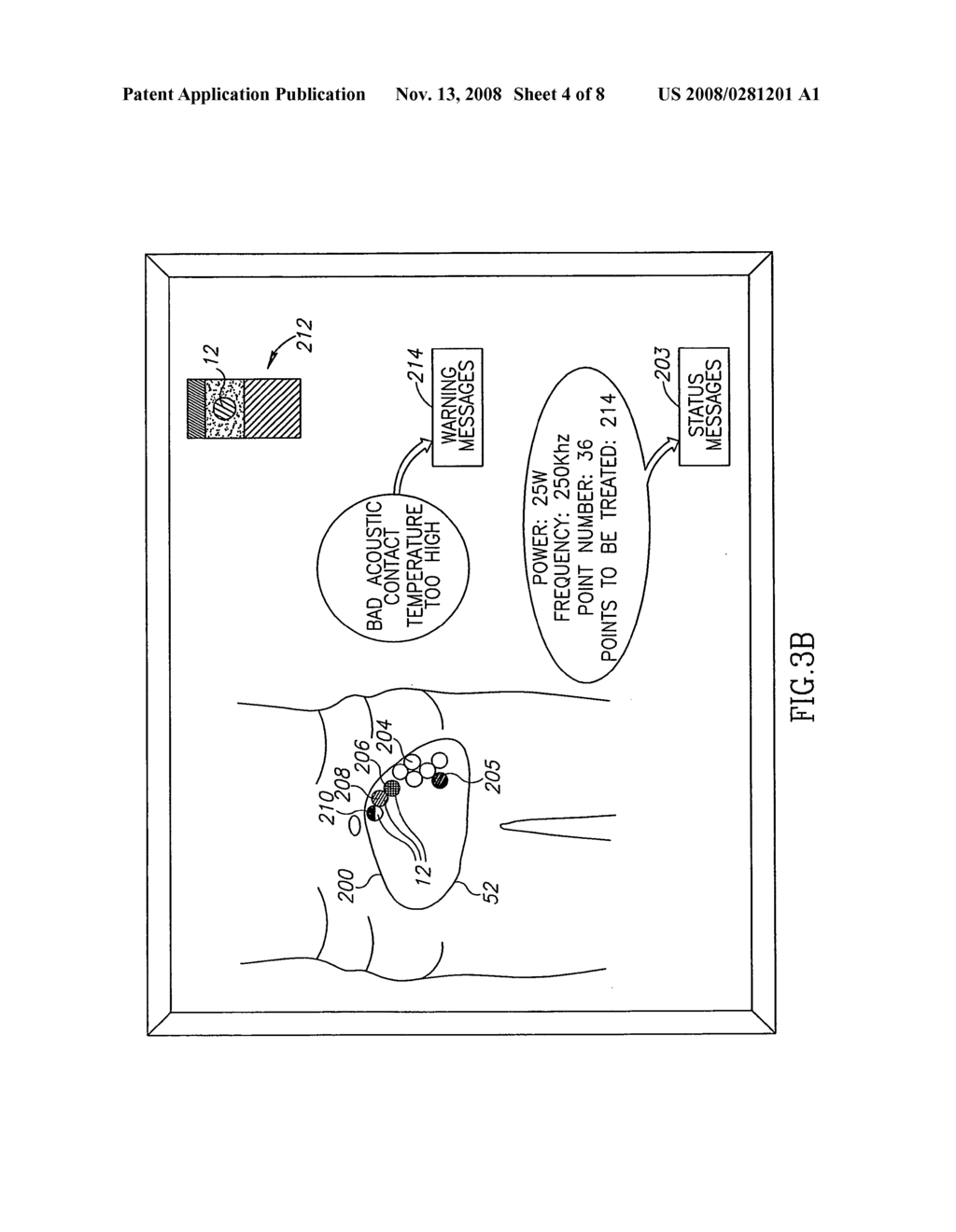 Non-invasive ultrasonic body contouring - diagram, schematic, and image 05