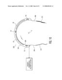 Transducer Cuff for Guidance and Application of High Intensity Focused Ultrasound for Control of Bleeding Due to Severed Limbs diagram and image