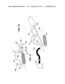 Needle Delivery System for Electrodes diagram and image