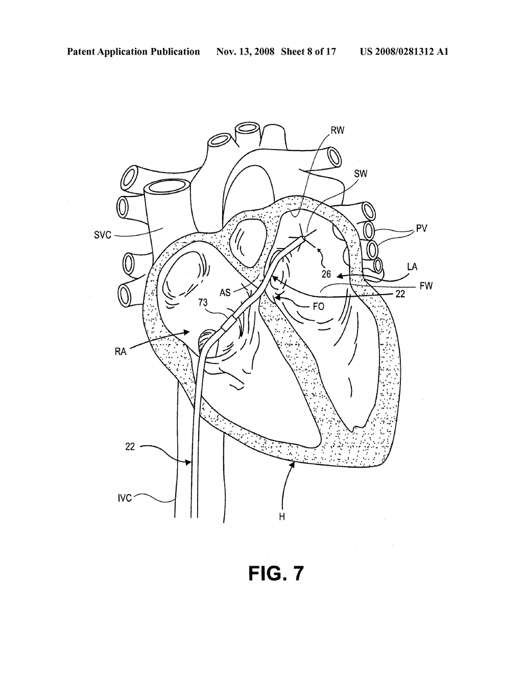 Ablation Therapy System and Method for Treating Continuous Atrial Fibrillation - diagram, schematic, and image 09