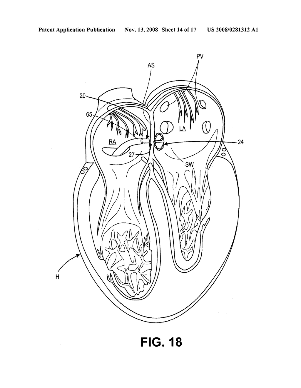 Ablation Therapy System and Method for Treating Continuous Atrial Fibrillation - diagram, schematic, and image 15