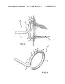 Treatment and diagnostic catheters with hydrogel electrodes diagram and image