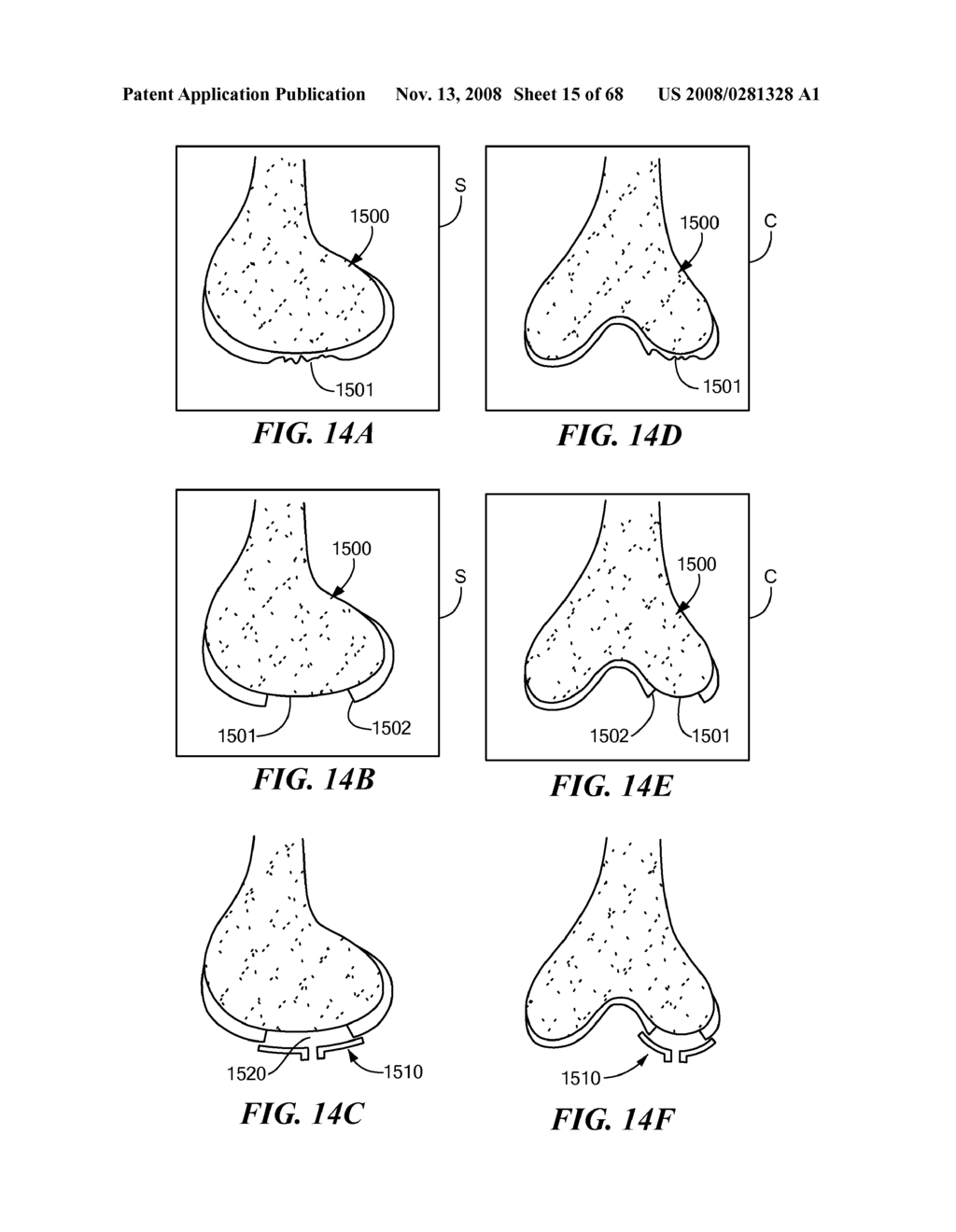 Surgical Tools for Arthroplasty - diagram, schematic, and image 16