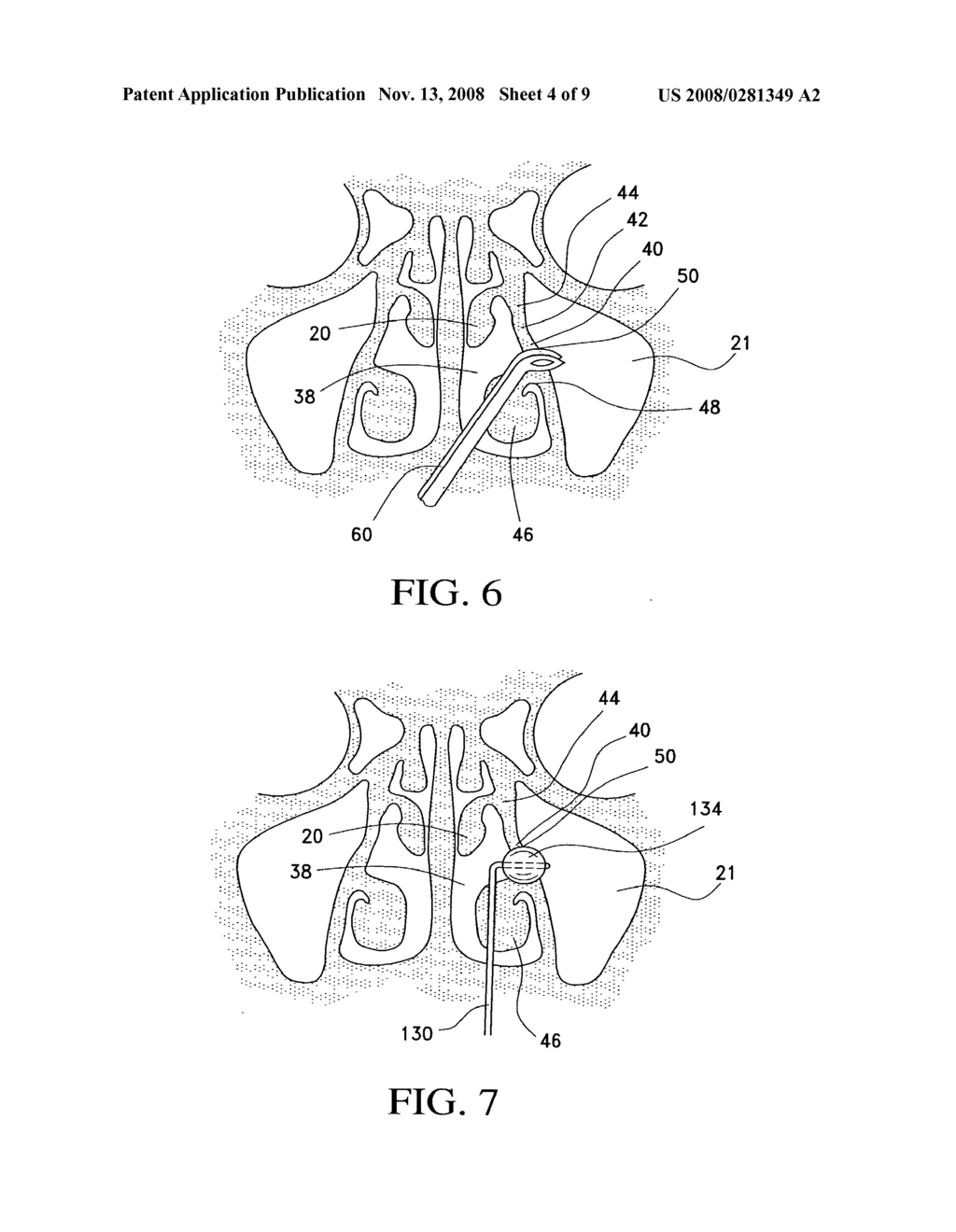 Balloon catheters and methods for treating paranasal sinuses - diagram, schematic, and image 05