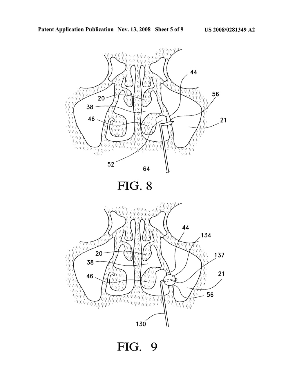 Balloon catheters and methods for treating paranasal sinuses - diagram, schematic, and image 06