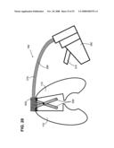 Gentle touch surgical stapler diagram and image