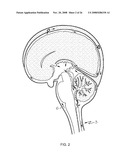 METHODS AND DEVICE TO NEUTRALIZE SOLUBLE TOXIC AGENTS IN THE BRAIN diagram and image