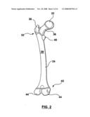 PATIENT-SPECIFIC SURGICAL GUIDANCE TOOL AND METHOD OF USE diagram and image