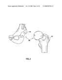 PATIENT-SPECIFIC SURGICAL GUIDANCE TOOL AND METHOD OF USE diagram and image