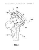 PATIENT-SPECIFIC SURGICAL GUIDANCE TOOL AND METHOD OF USE diagram and image
