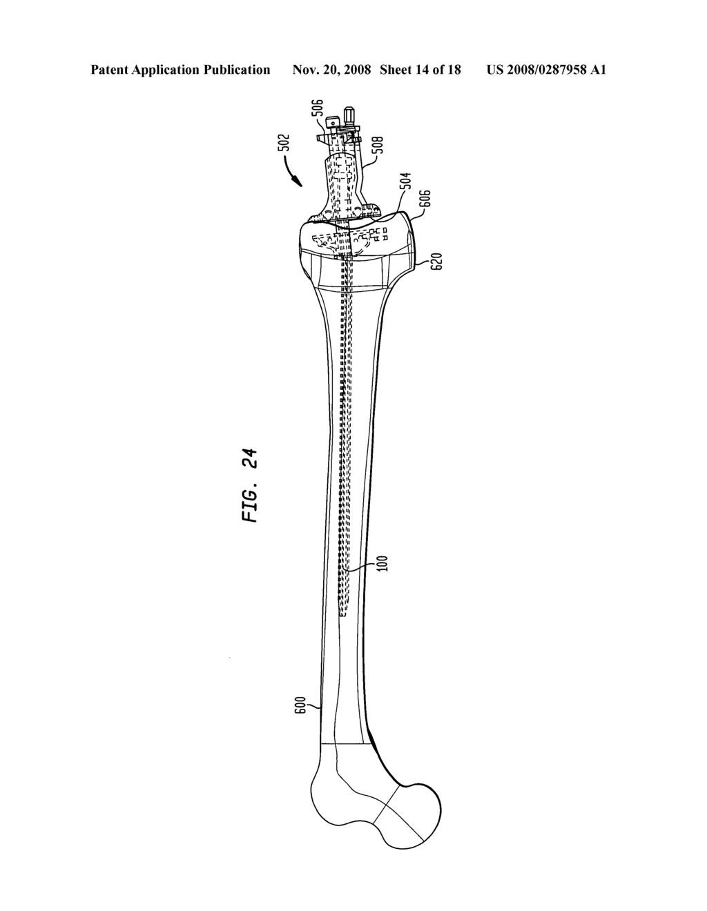 Flexible intramedullary rod - diagram, schematic, and image 15