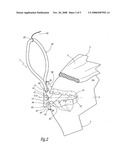 Surgical method for suturing soft tissue to a bone, in particular the rotator cuff to the humerus diagram and image