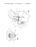 Surgical method for suturing soft tissue to a bone, in particular the rotator cuff to the humerus diagram and image