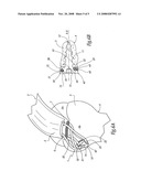 Surgical method for suturing soft tissue to a bone, in particular the rotator cuff to the humerus diagram and image