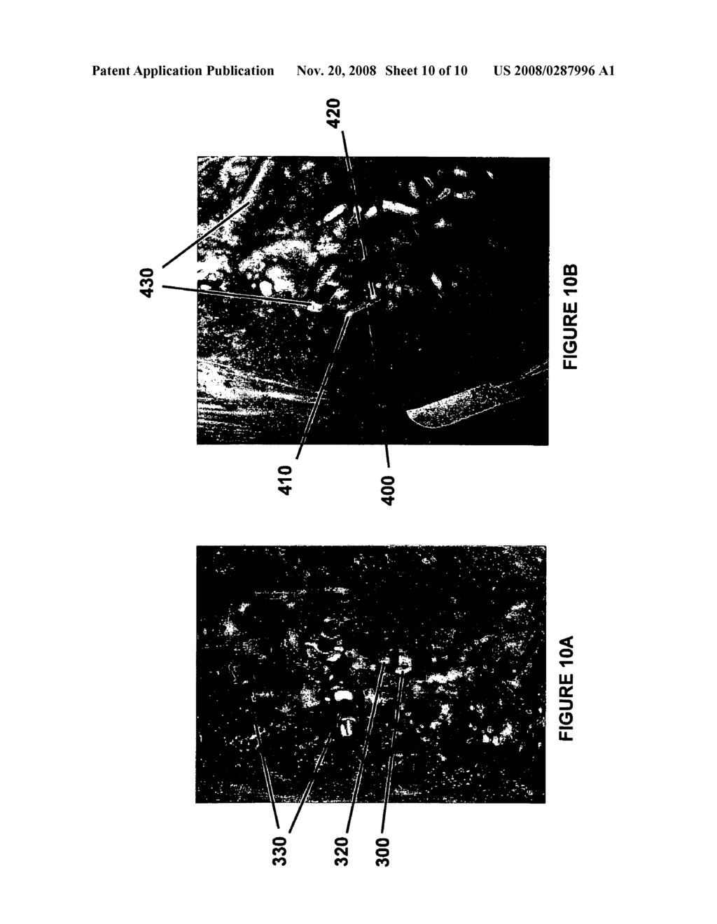 Method and device for treating scoliosis - diagram, schematic, and image 11