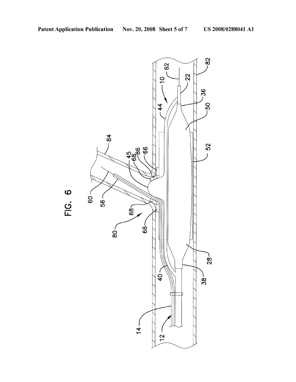 Cutting Member for Bifurcation Catheter Assembly - diagram, schematic, and image 06