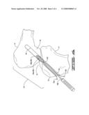 Threaded pulley anchor apparatus and method for use in surgical repair of ligament or tendon diagram and image