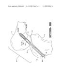 Threaded pulley anchor apparatus and method for use in surgical repair of ligament or tendon diagram and image