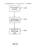 OPEN LUMEN STENT diagram and image