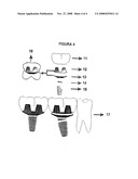 Splint Abutment Over Osseointegrated Implant and Compensatory Slated Coping diagram and image