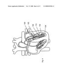 SYSTEMS AND METHODS FOR VOLUME REDUCTION diagram and image