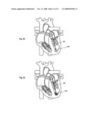 SYSTEMS AND METHODS FOR VOLUME REDUCTION diagram and image