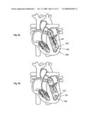 SYSTEMS AND METHODS FOR VOLUME REDUCTION diagram and image