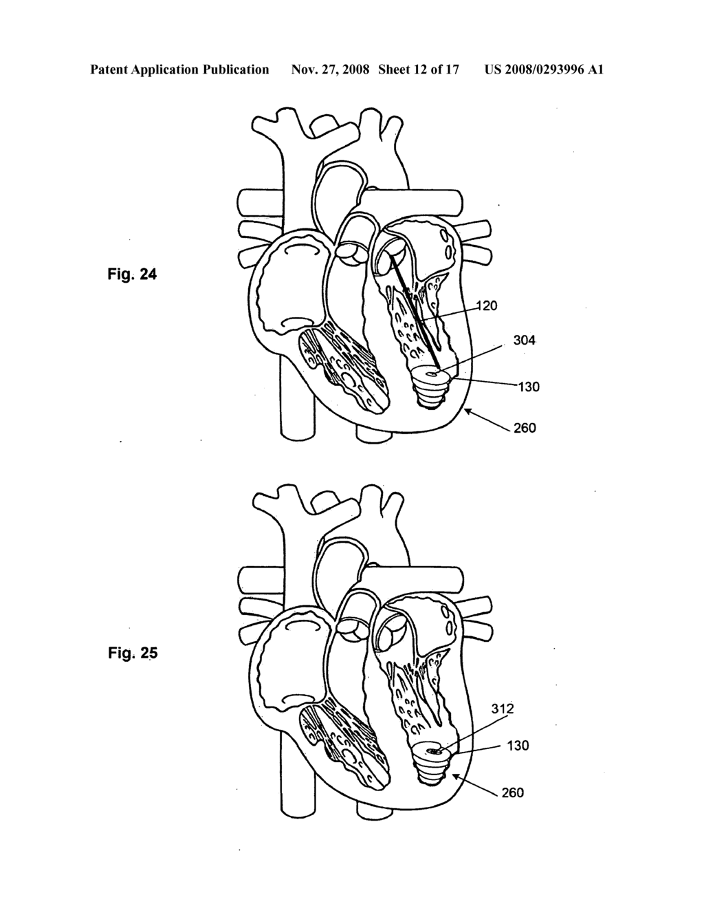 SYSTEMS AND METHODS FOR VOLUME REDUCTION - diagram, schematic, and image 13