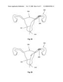 SYSTEMS AND METHODS FOR VOLUME REDUCTION diagram and image