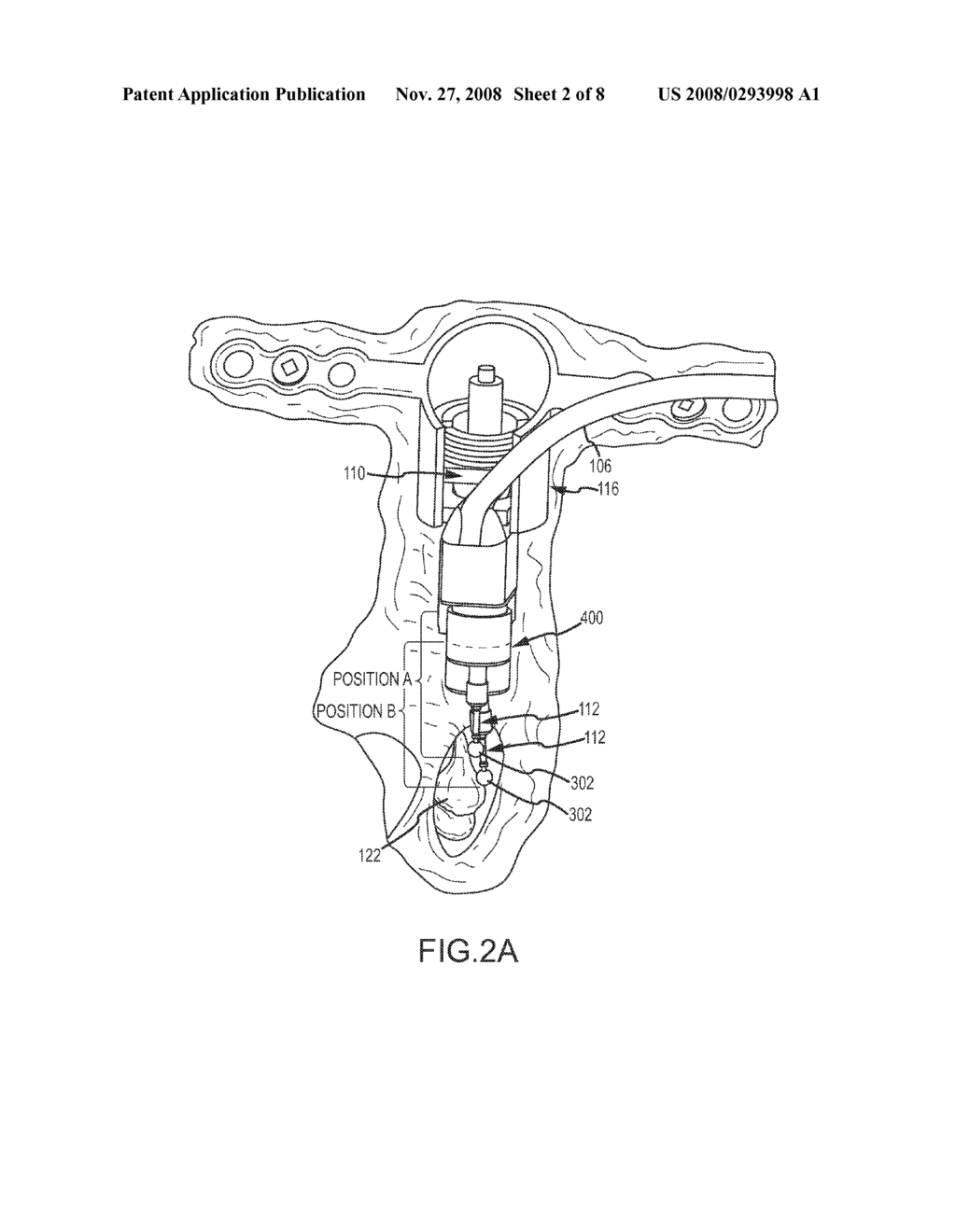 LATERAL COUPLING OF AN IMPLANTABLE HEARING AID ACTUATOR TO AN AUDITORY COMPONENT - diagram, schematic, and image 03