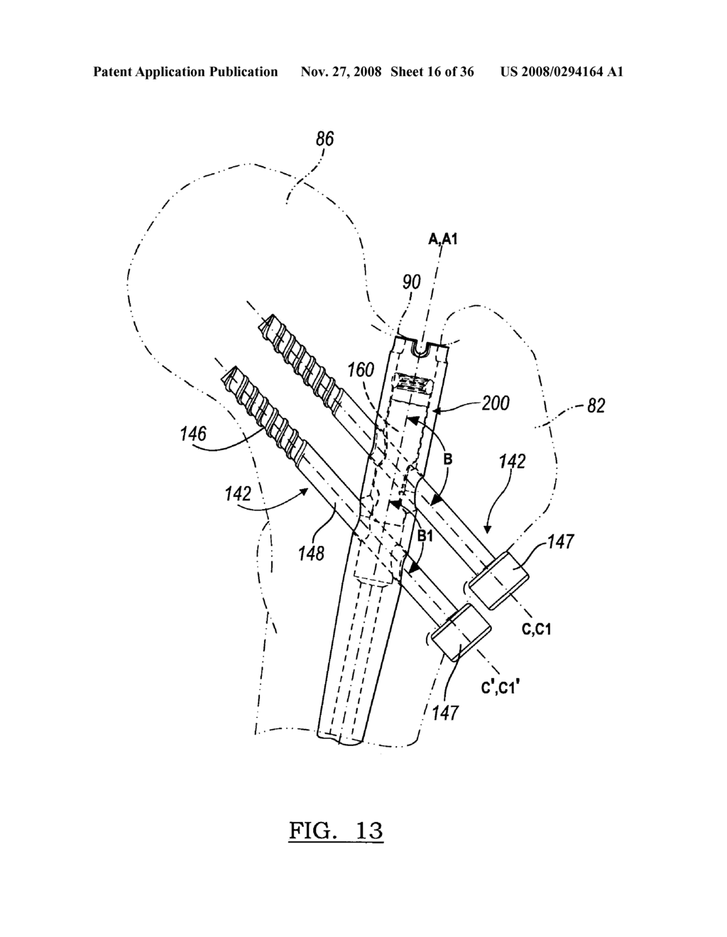 LOCKABLE INTRAMEDULLARY FIXATION DEVICE - diagram, schematic, and image 17