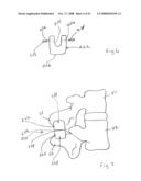 Spinous process implants and methods of using the same diagram and image