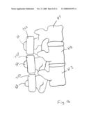 Spinous process implants and methods of using the same diagram and image