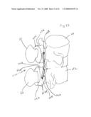 Spinous process implants and methods of using the same diagram and image