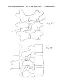 Spinous process implants and methods of using the same diagram and image