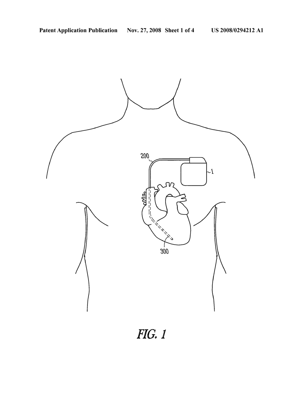 Trending of systolic murmur intensity for monitoring cardiac disease with implantable device - diagram, schematic, and image 02