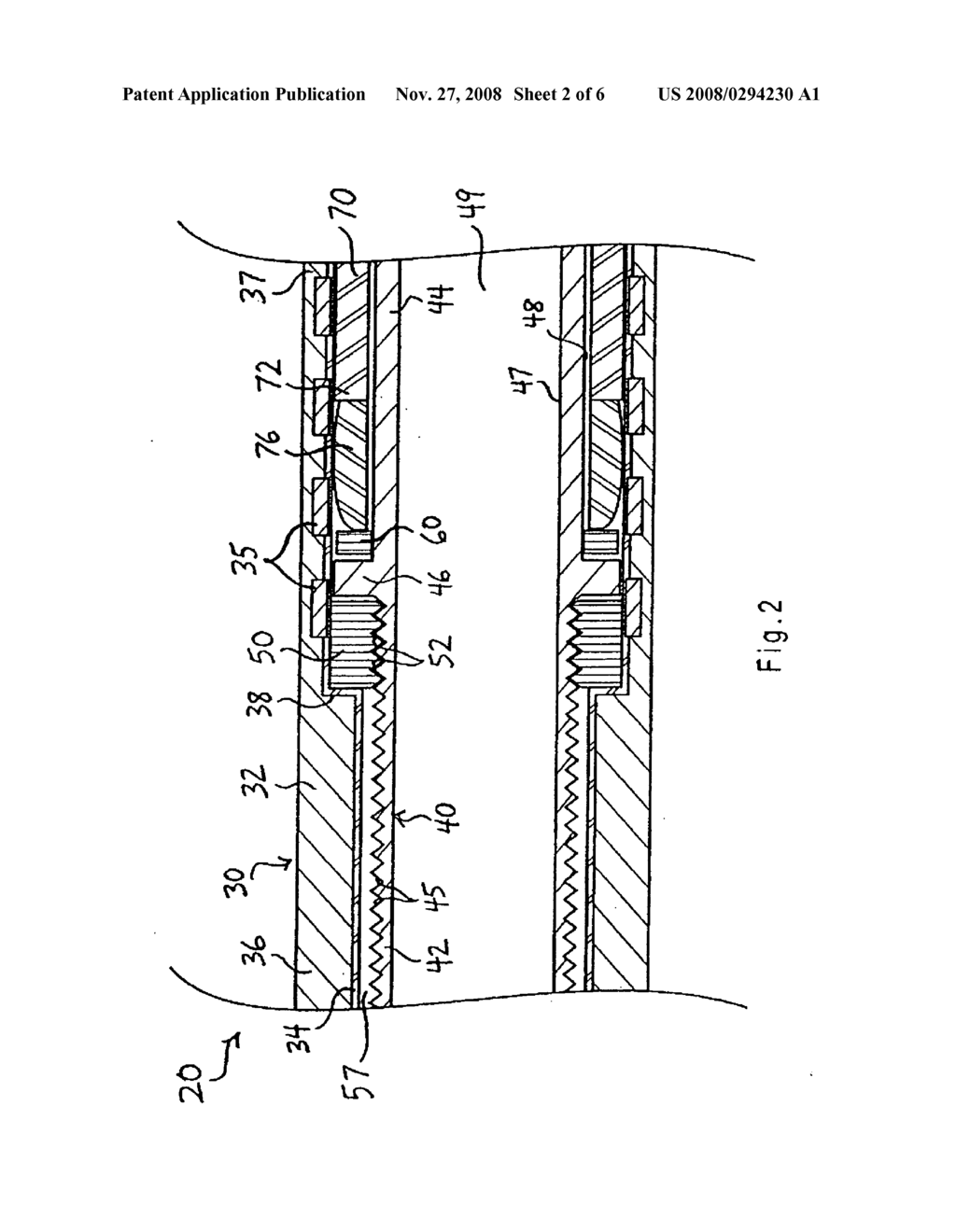 Apparatus and methods for deploying self-expanding stents - diagram, schematic, and image 03