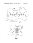 STENT GRAFTS FOR THE THORACIC AORTA diagram and image