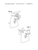 BRIDGE ELEMENT FOR LUNG IMPLANT diagram and image