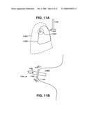 BRIDGE ELEMENT FOR LUNG IMPLANT diagram and image