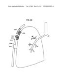 BRIDGE ELEMENT FOR LUNG IMPLANT diagram and image