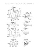 INTEROCCLUSAL APPLIANCE AND METHOD diagram and image