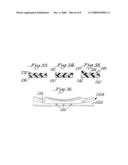 INTEROCCLUSAL APPLIANCE AND METHOD diagram and image