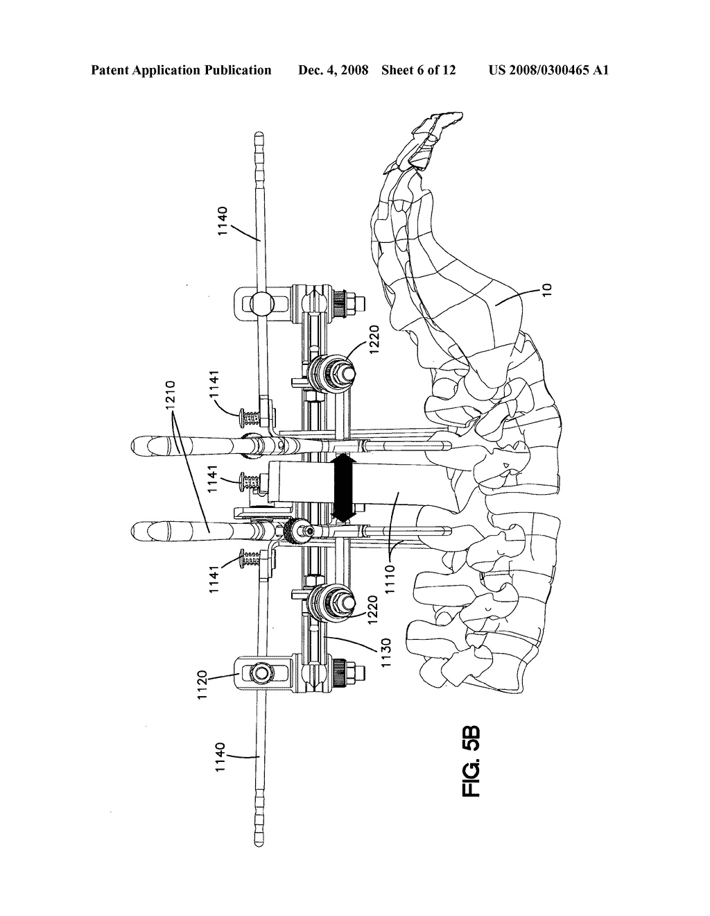 Spine Retractor and Distractor Device - diagram, schematic, and image 07