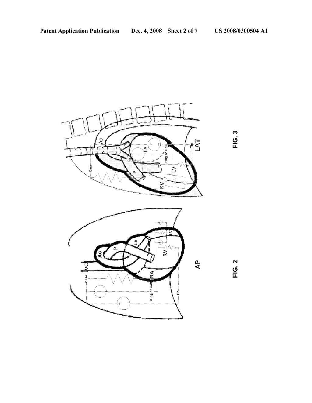 IMPLANTABLE MEDICAL DEVICES EVALUATING THORAX IMPEDANCE - diagram, schematic, and image 03