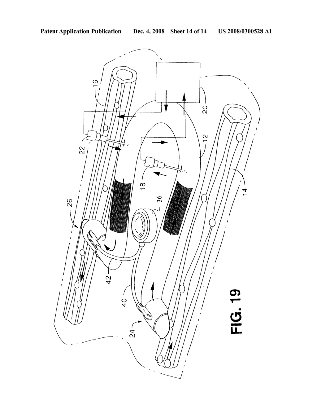 Arteriovenous access valve system and process - diagram, schematic, and image 15