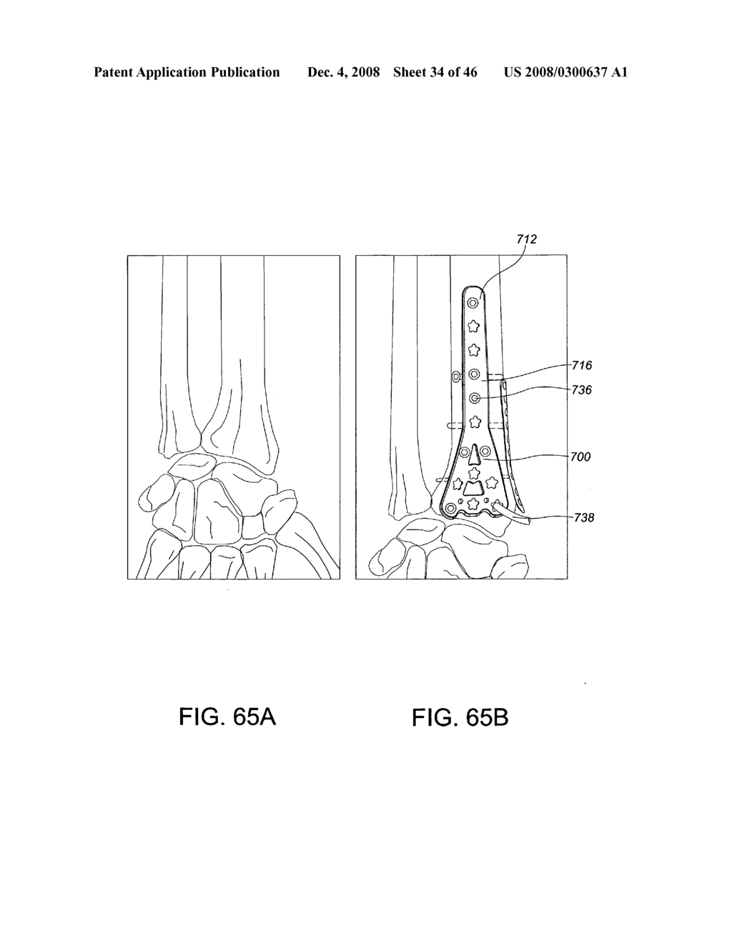 Systems and methods for using polyaxial plates - diagram, schematic, and image 35