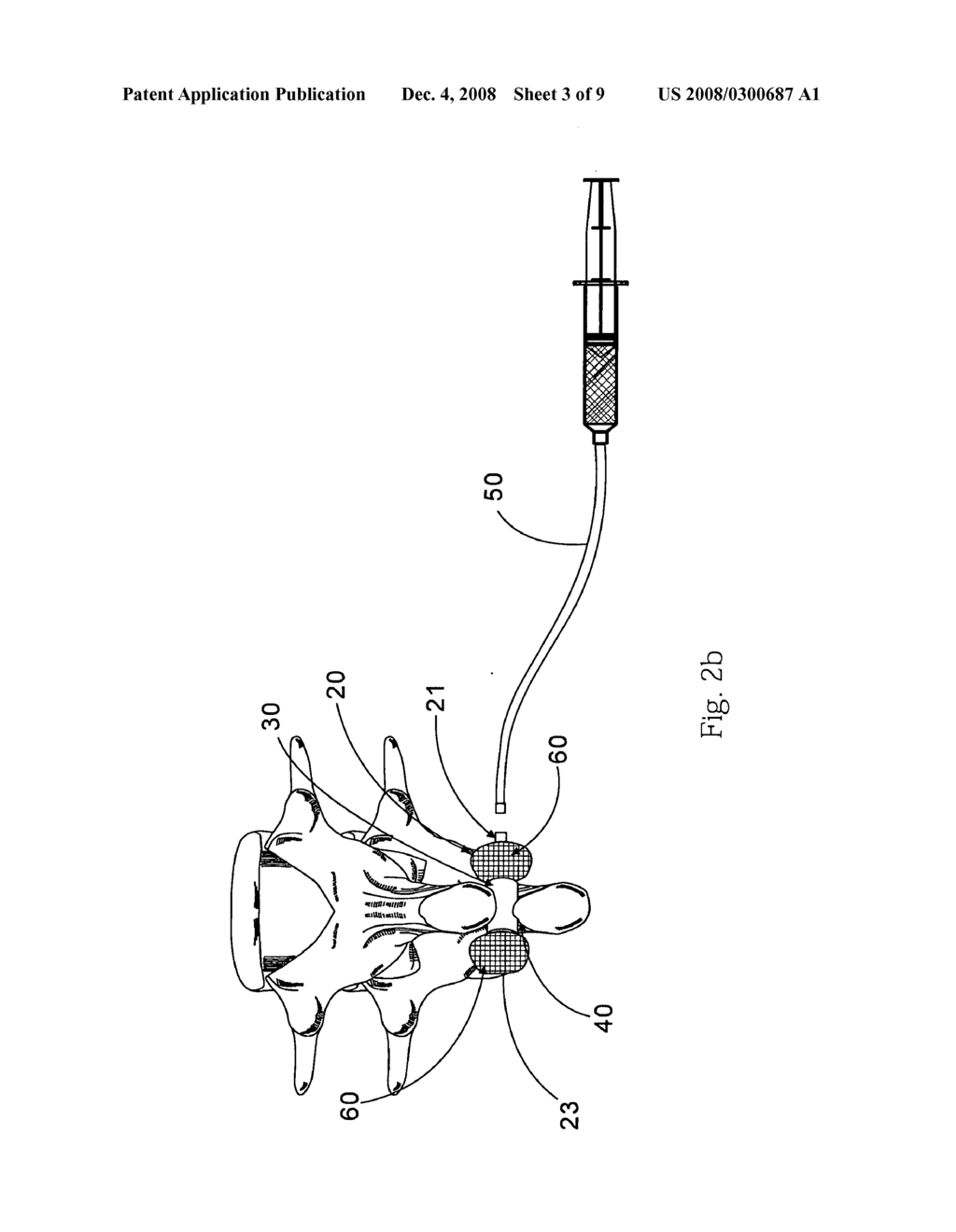 Medical implantation device for spine - diagram, schematic, and image 04