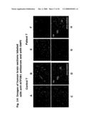 Diagnostic and Therapeutic use of a Plasma Membrane Atpase diagram and image