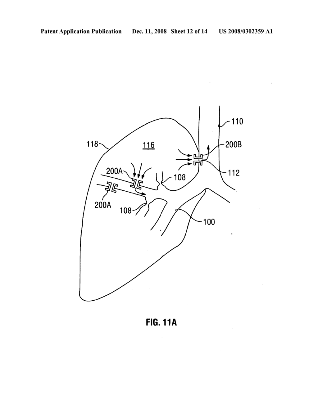 EXTRAPLEURAL AIRWAY DEVICE AND METHOD - diagram, schematic, and image 13